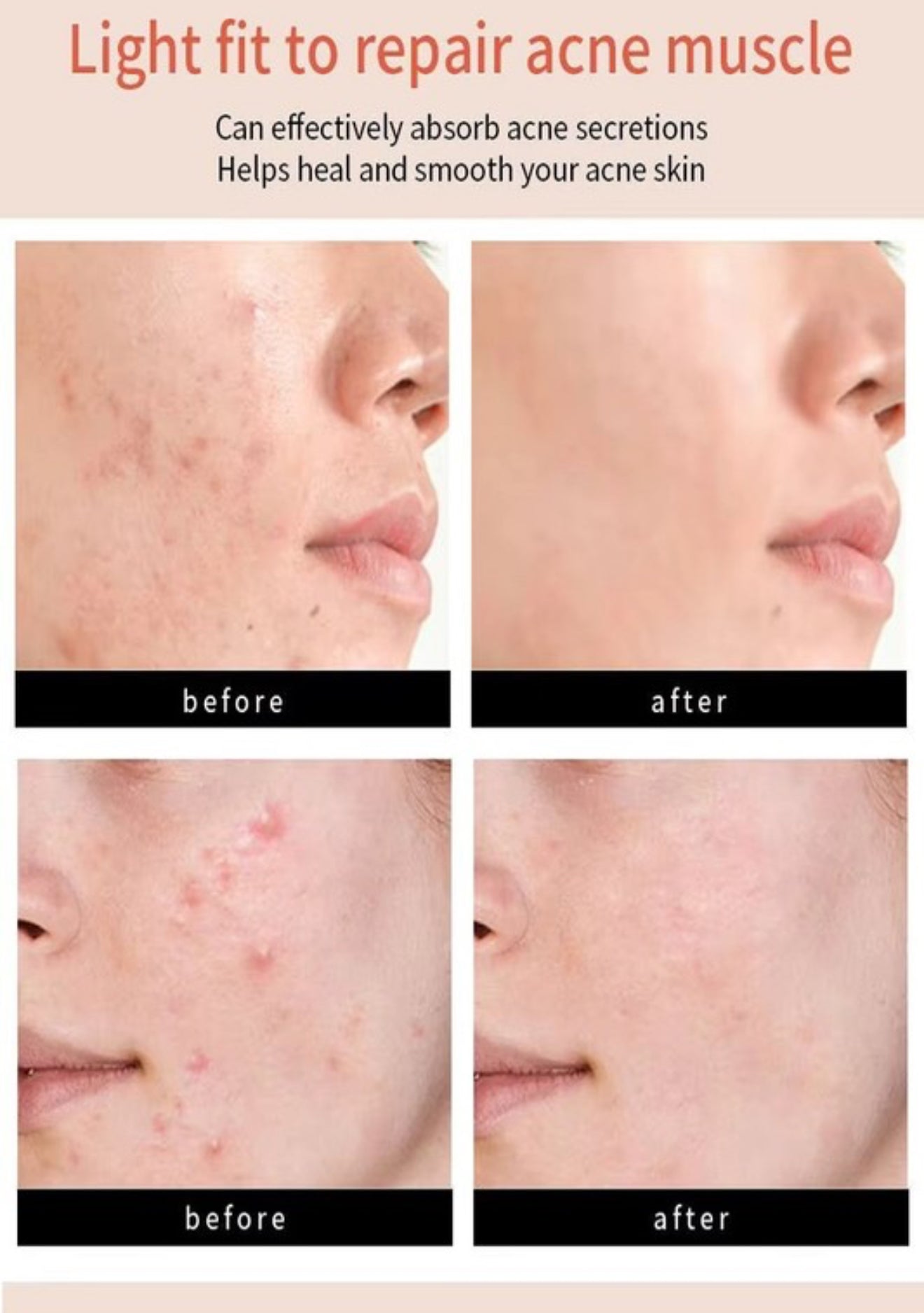 THE ORIGINAL HYDROCOLLOID ACNE PIMPLE PATCH