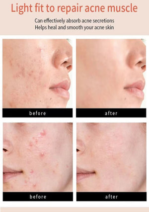 THE ORIGINAL HYDROCOLLOID ACNE PIMPLE PATCH